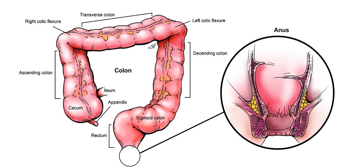 Total Proctocolectomy