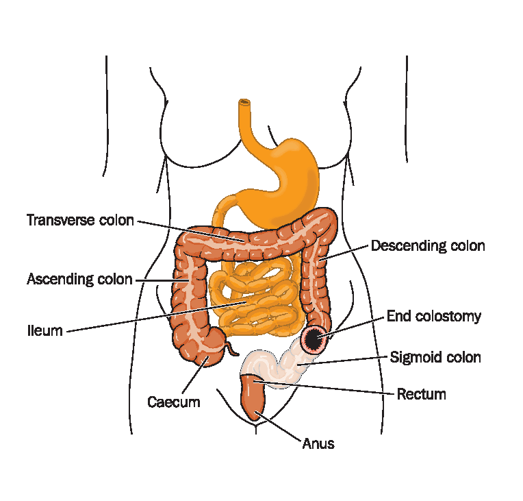Colostomy