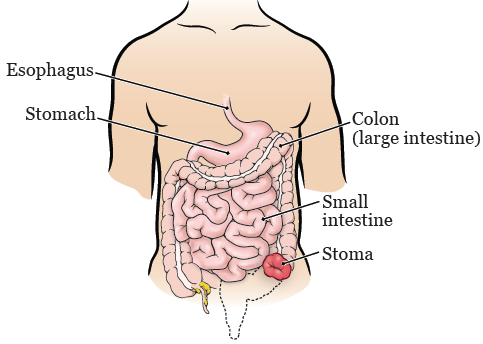 Abdomino-Perineal Resection