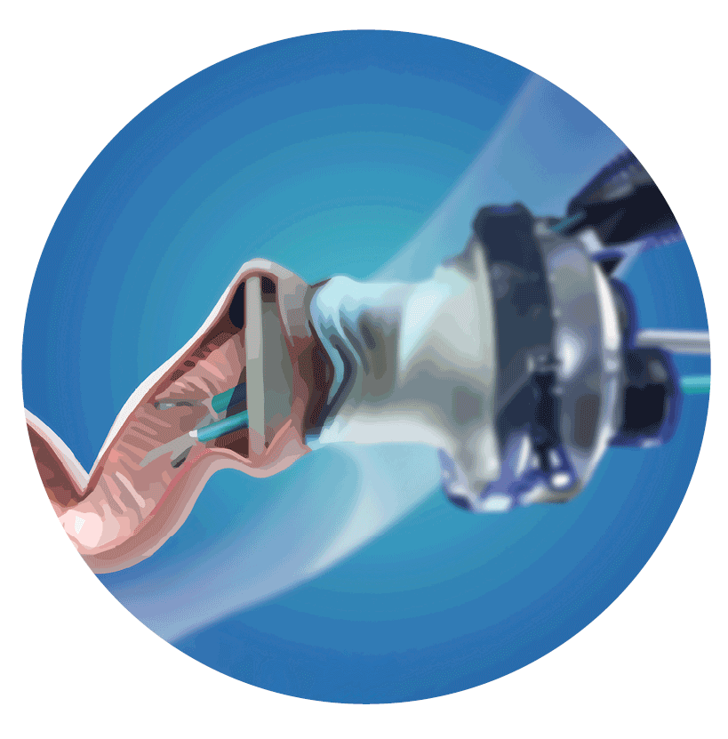 Trans-Anal Minimal Invasive Surgery