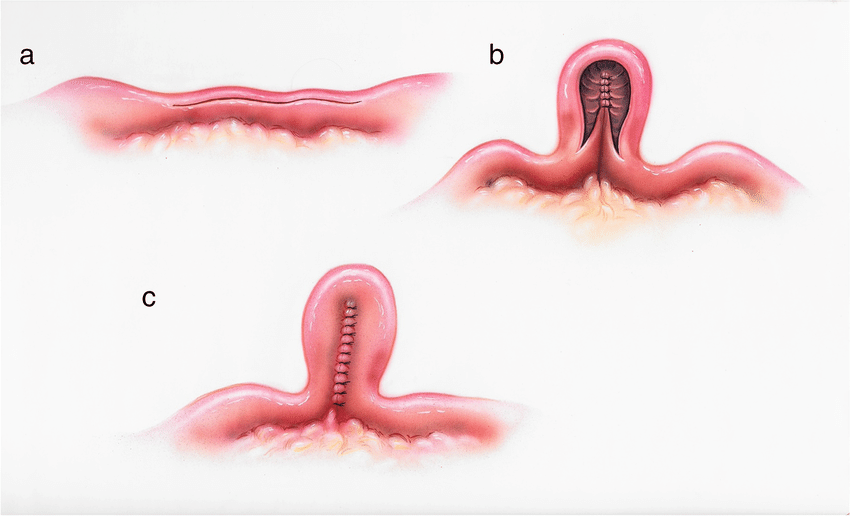 Stricturoplasty for Strictures
