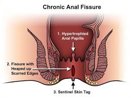 Anal Fissure