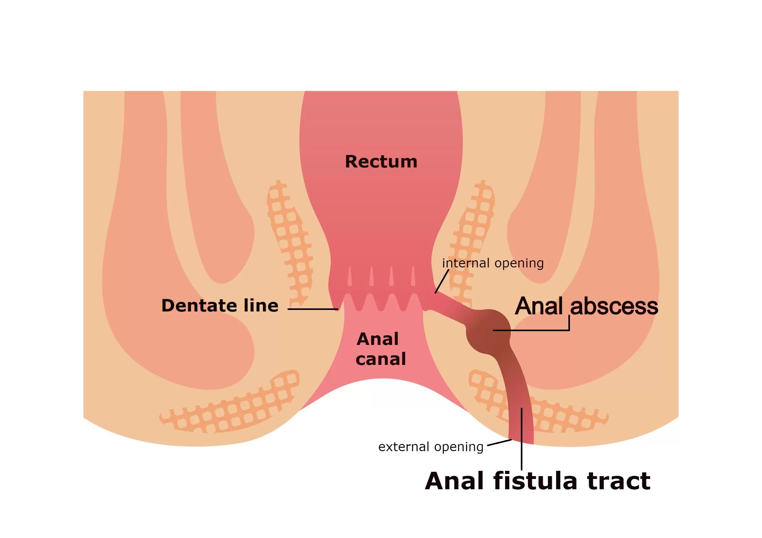 Anal Fistula