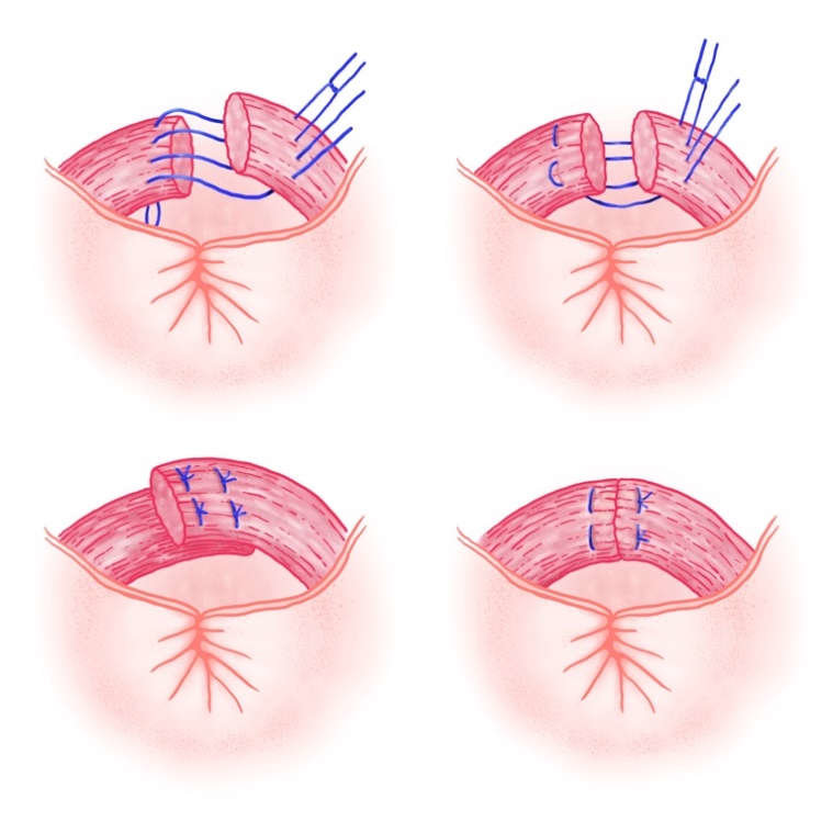 Anal Sphincter Repair