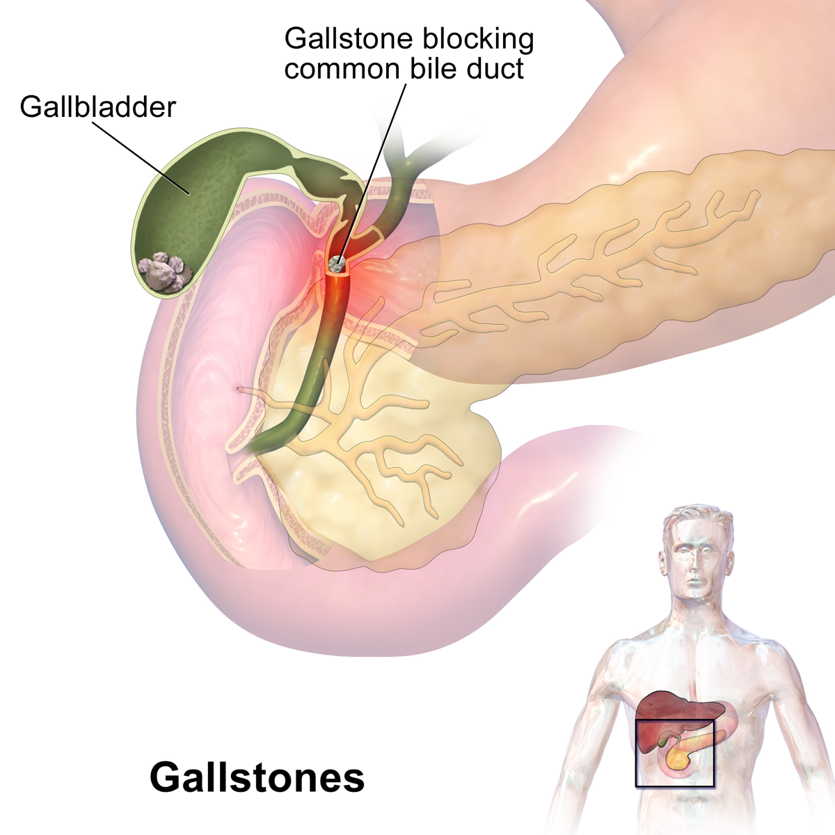 Gallbladder Stones and Cholecystectomy