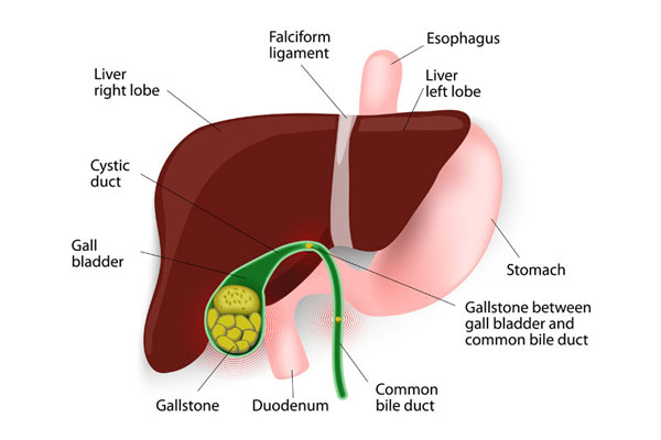 CBD Explorations for Stones in the Bile Duct