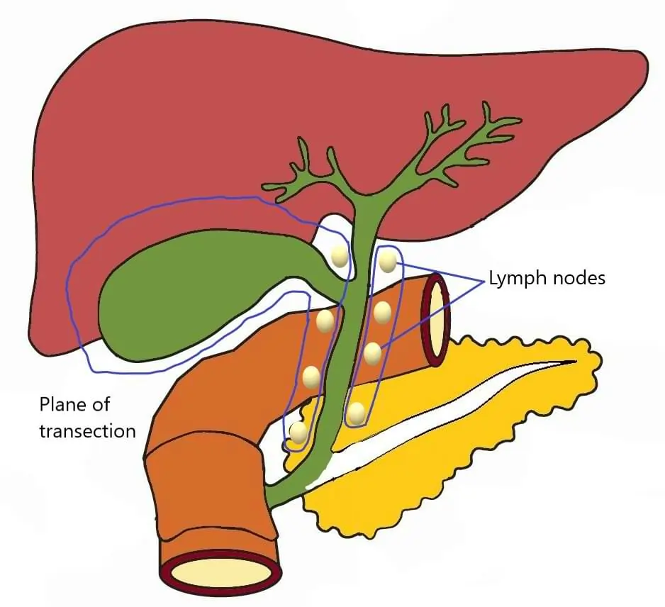 Radical Cholecystectomy for Cancers