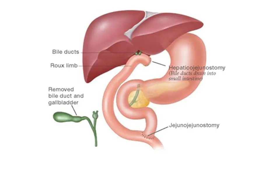 Hepatico-jejunostomy for Strictures