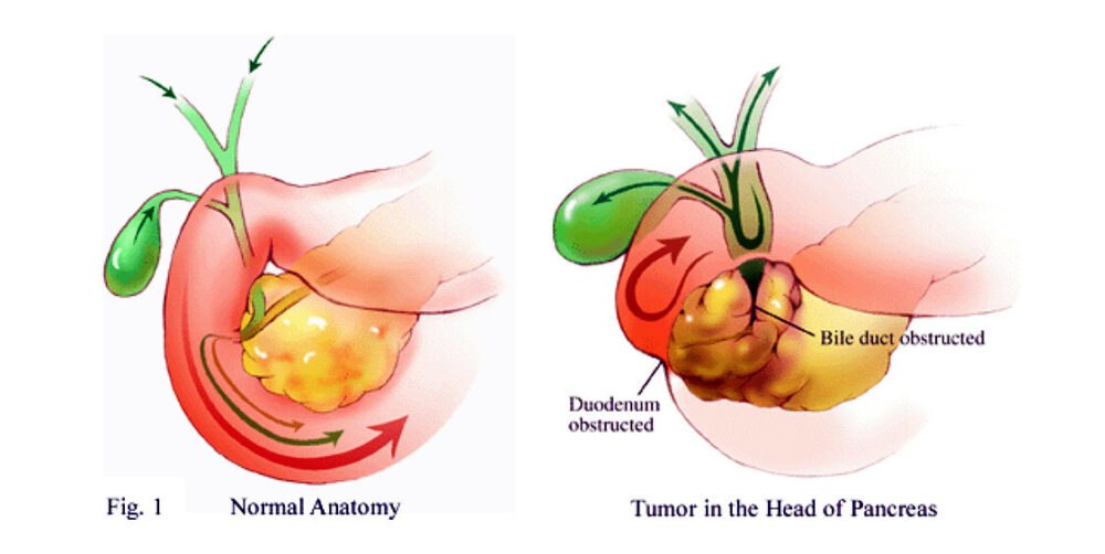 Biliary Bypass for Cancers