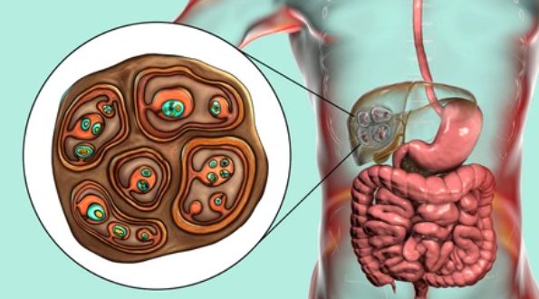 Hydatid Cyst Excision