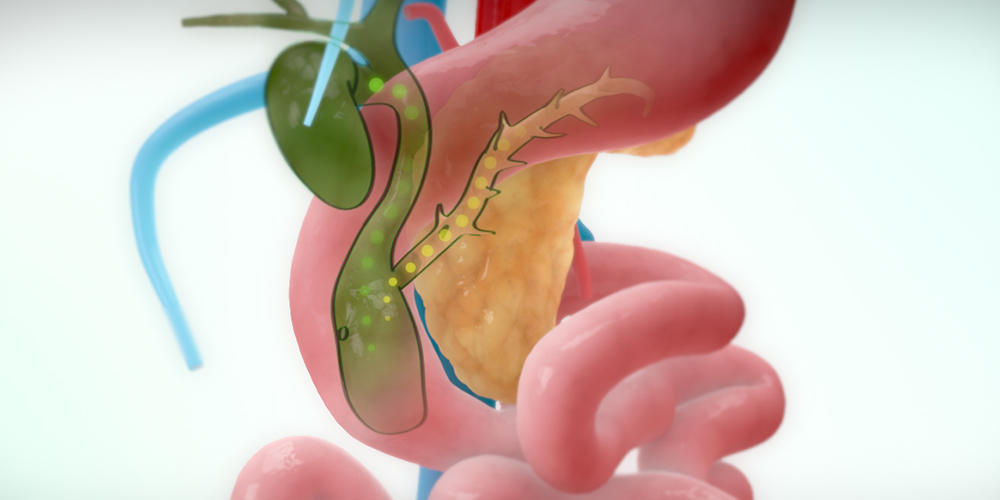 Choledochal Cyst Excision