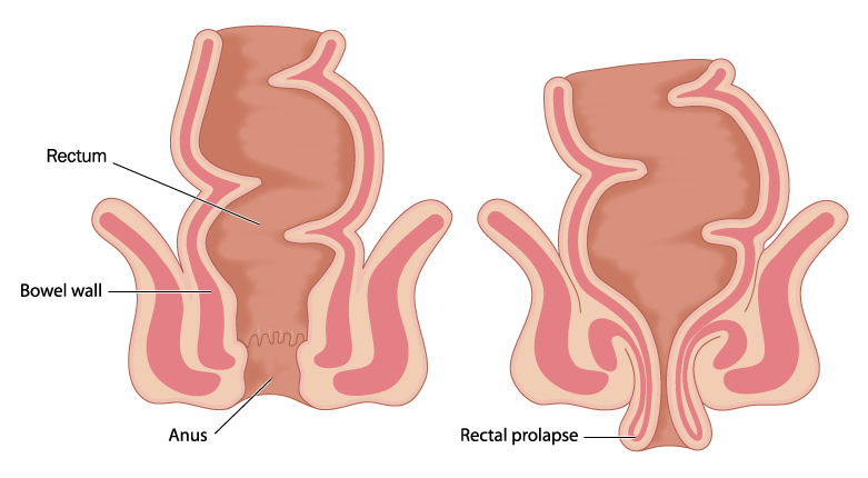 Rectal Prolapse Repairs