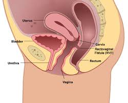 Repairs for Recto-Vaginal Fistulas