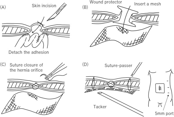 Intra-peritoneal On-lay Repairs