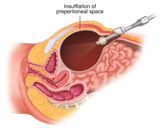 Totally Extra-peritoneal Repair