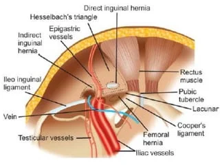 Trans-abdominal Pre-peritoneal Repair