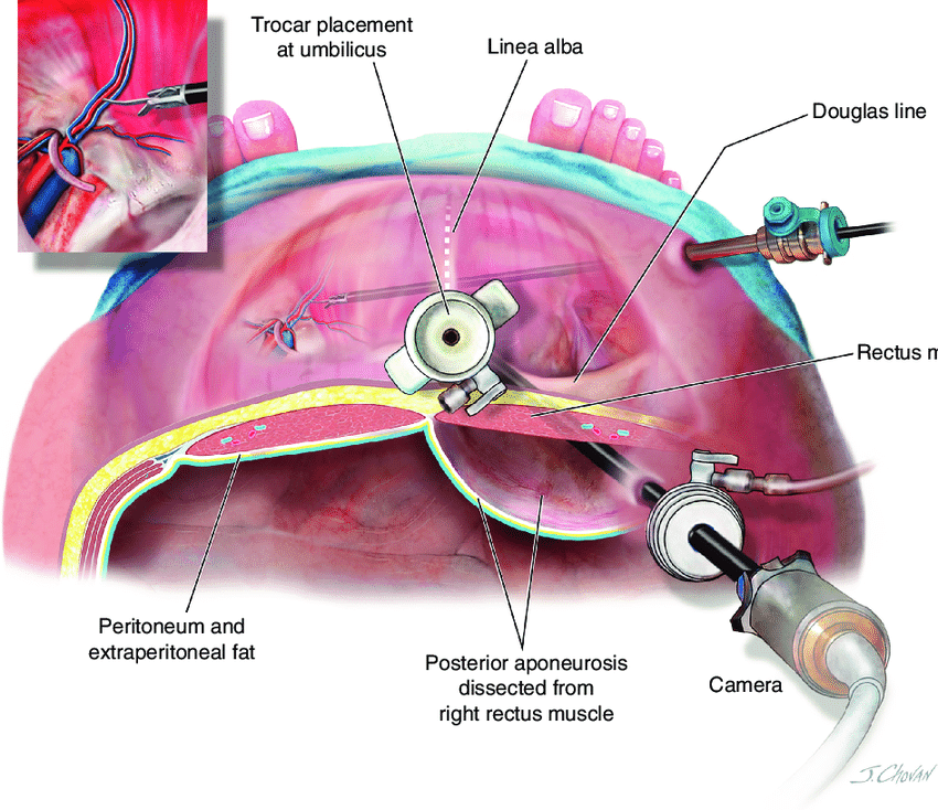 Extended View Totally Extra-peritoneal Repair