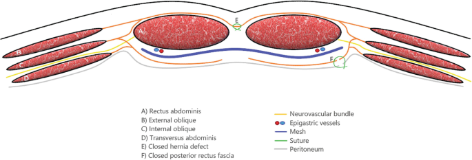 Trans-abdominal Retro-muscular Repair