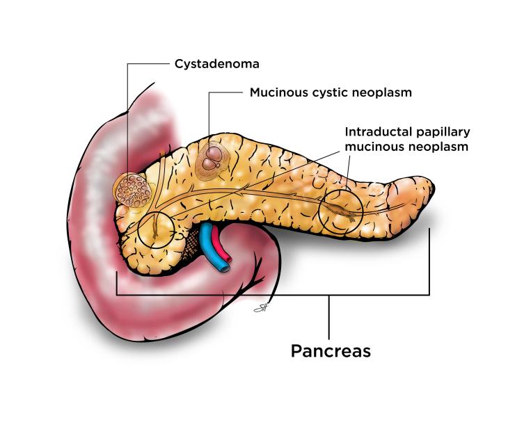 Excision of Cystic Tumours / Haemangioma
