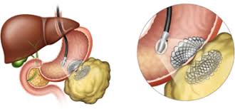 Cysto-gastrostomy or Jejunostomy