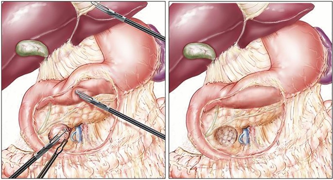 Enucleation of Cystic Lesions
