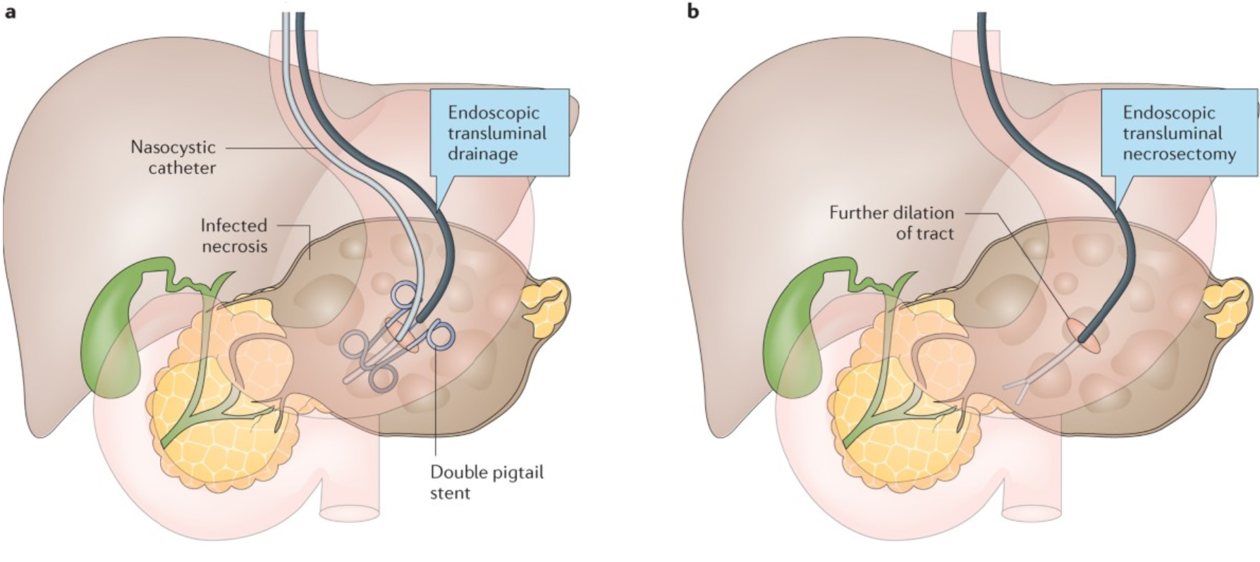 Necrosectomy for Necrotizing Pancreatitis