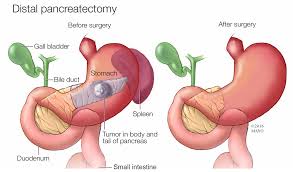 Distal Pancreatectomy for Tumours and Trauma