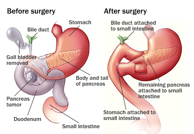 Whipple's Procedure for Peri-ampullary Cancers