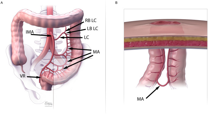Ileostomy for Diversion