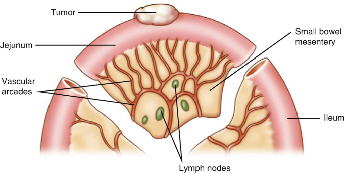 Segmental Resection of Small Intestine