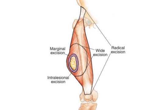 Radical Resections for Cancerous Lesions