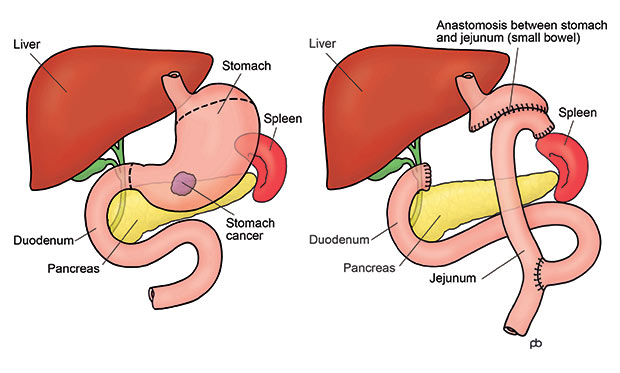 Gastrectomy for Cancer and Other Diseases of Stomach