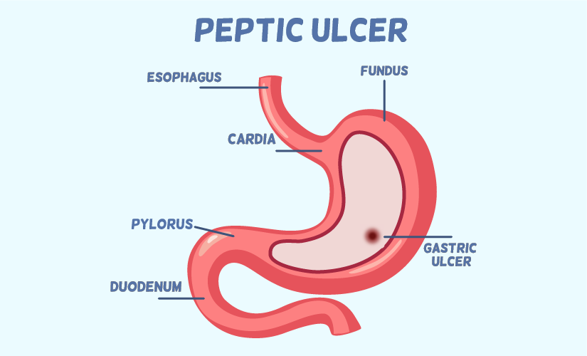 Acid-Peptic Diseases & Gastro-Jejunostomy