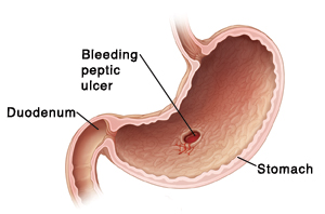 Control of Gastric / Duodenal Bleed