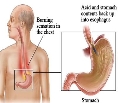 Surgery for Corrosive Injury to Stomach and Duodenum