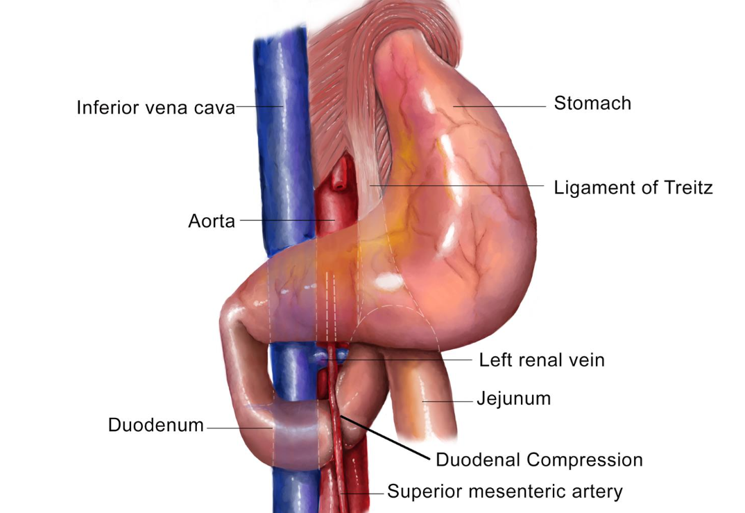 Gastric / Duodenal Bypass for SMA Syndrome