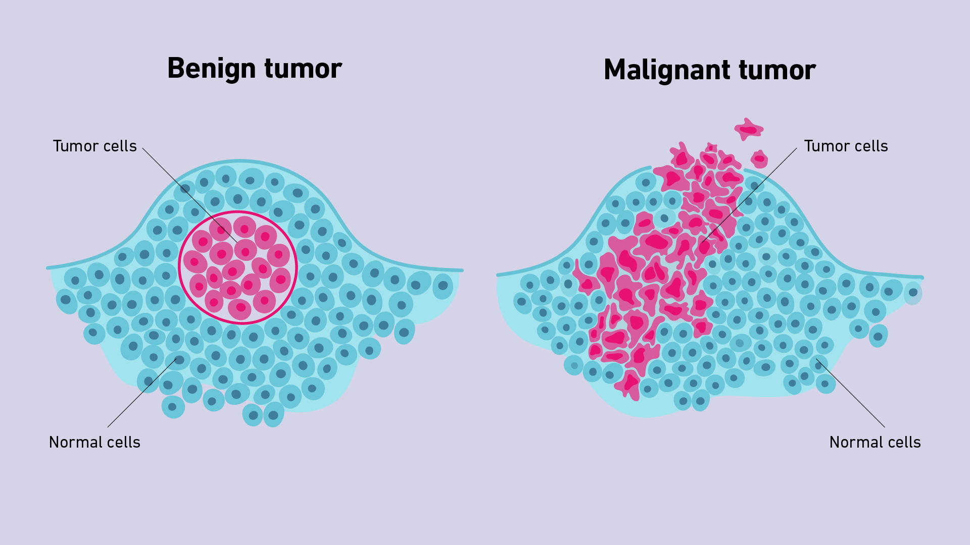 Benign Tumours